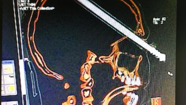 Colpito in faccia dalla fiocina, il 14enne è vivo e non perderà la vista 