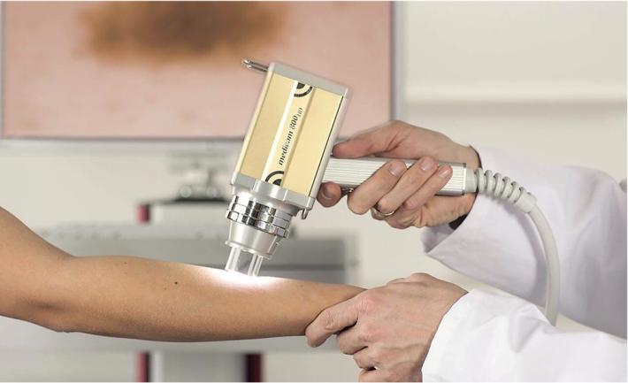 Prevenire il melanoma con la mappatura dei nei