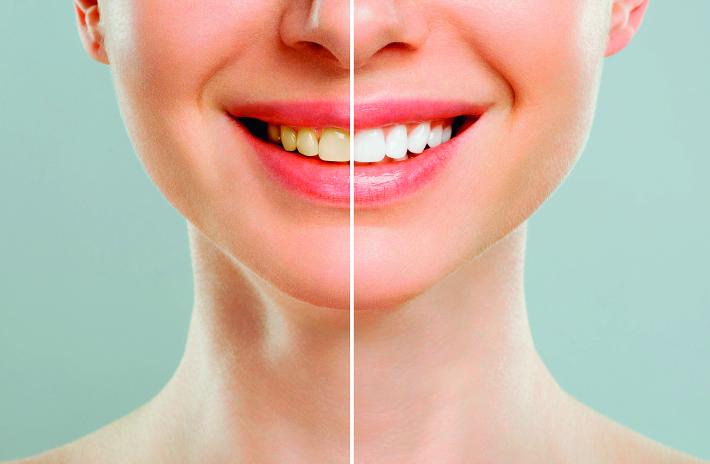 Denti bianchi