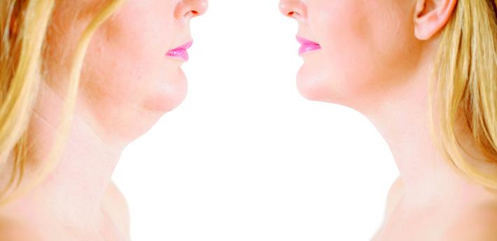 Vade retro doppio mento Rimedi  &laquo;soft&raquo; e chirurgia