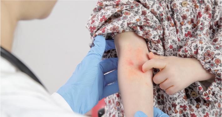 Dermatite atopica: problema comune tra i bimbi