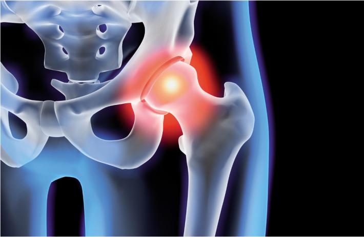 ARTROSI DELL&rsquo;ANCA: QUALE TRATTAMENTO EFFETTUARE?