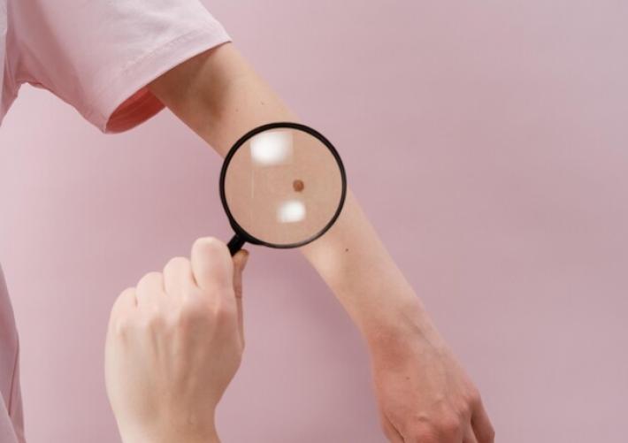 Melanoma, in Italia +7% casi l'anno, fondamentale prevenzione