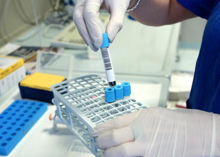 Allerta Ecdc per epatite A, focolaio con 303 casi in 7 Paesi