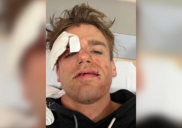 Jacopo dei 'iPantellas" picchiato e rapinato a Varese