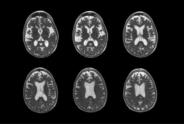 Stati Uniti, la Fda autorizza un atteso farmaco contro l'Alzheimer 