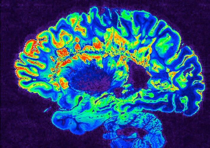 cervello sclerosi multipla