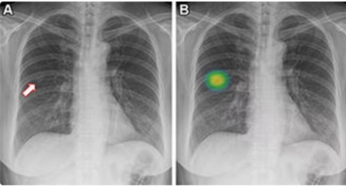 L'Ai svela i non fumatori a rischio di cancro ai polmoni