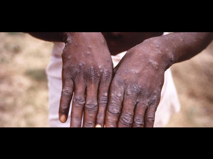 Vaiolo delle scimmie, sette persone contagiate in Friuli