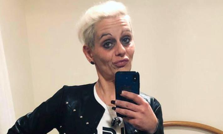 Aggredito con acido dalla ex, condizioni in miglioramento