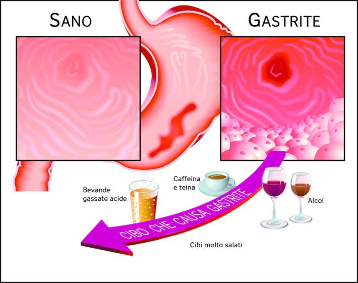 Asma, tosse e denti rovinati? Pu&ograve; essere il reflusso gastroesofageo