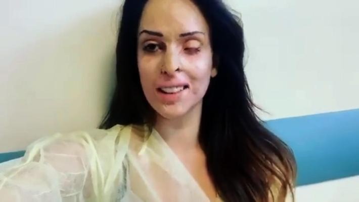 Gessica Notaro: 'Bene l'intervento all'occhio. Ora spero nel trapianto della cornea'