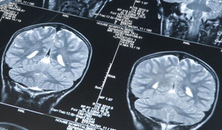 Tumori cervello, un software 'bravo' come i medici nella  diagnosi