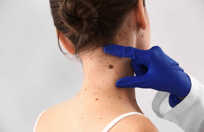 Tieni d'occhio i nei,  come riconoscere quelli sospetti