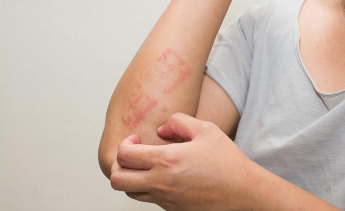 Psoriasi, un nuovo farmaco ottiene la rimborsabilit&agrave; dall'Aifa