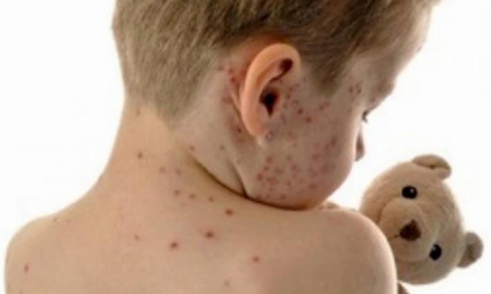Morbillo: a Parma colpiti soprattutto gli adulti