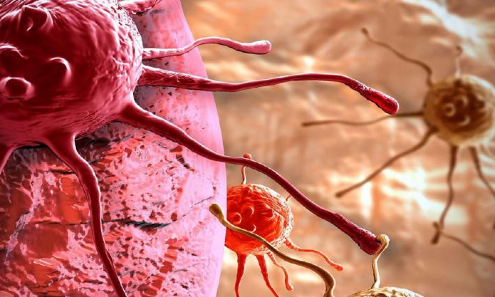 Australia, estratto un verme parassita dal cervello di una donna