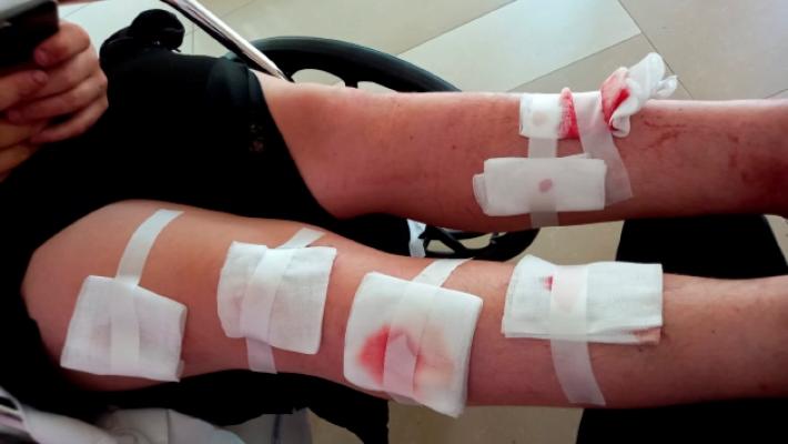 Felino, due ragazzini feriti dal lancio di un ordigno