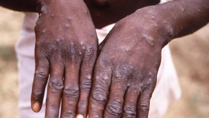 Franco Lori: &laquo;Le risposte al vaiolo delle scimmie? Ricerca, ricerca, ricerca&raquo;