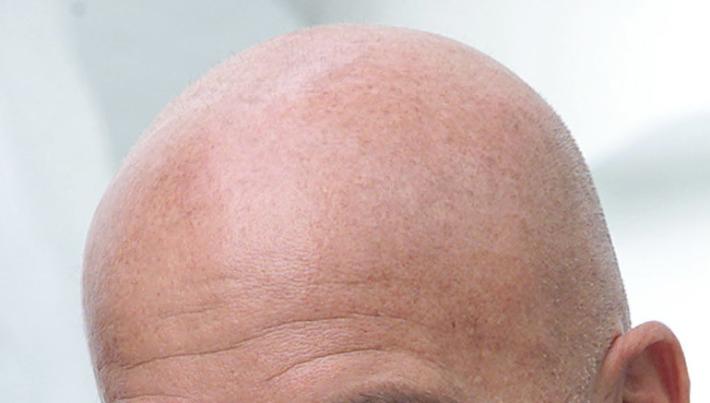 "Il farmaco per i capelli mi ha reso impotente", denuncia a pm