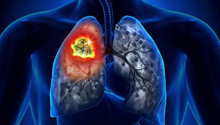 Migliora la sopravvivenza con l'addio al fumo