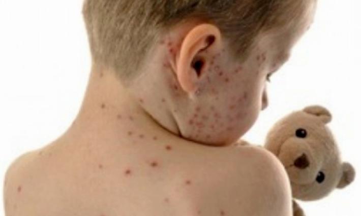 Morbillo: anche a Parma casi in aumento