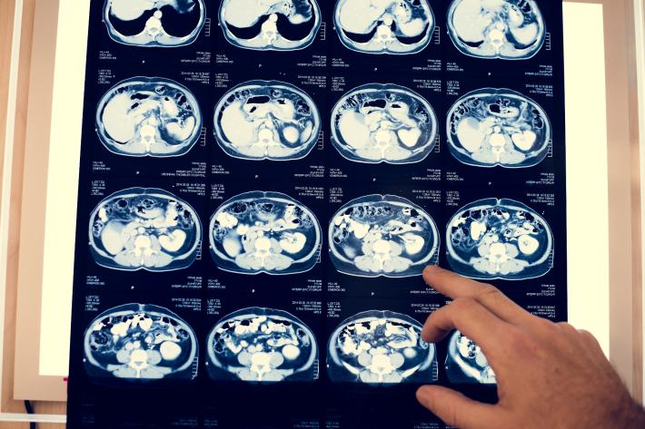 Tumore del Pancreas: conosci i campanelli d&rsquo;allarme?