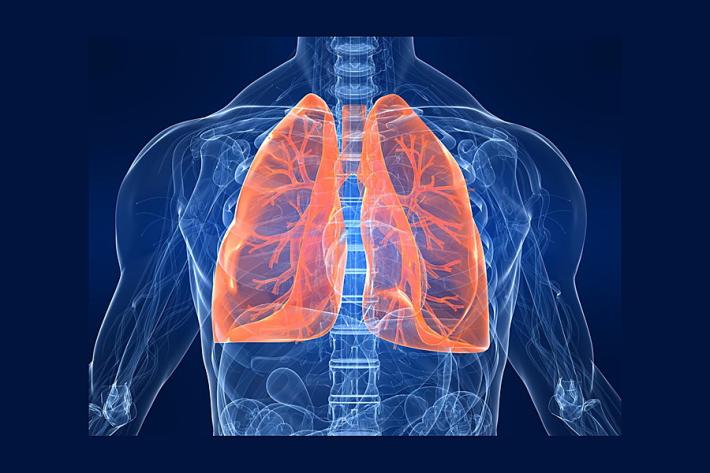 Asma, s&igrave; alla messa in commercio della prima tripla terapia in un unico inalatore. E' "firmata" Chiesi