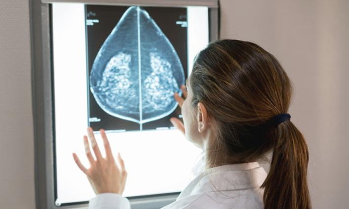 Tumore al seno, terapia mirata allunga la vita