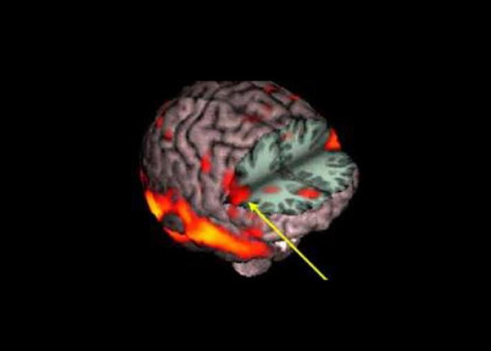 Riabilitazione dell'ictus, al via uno studio parmigiano tra realt&agrave; virtuale e neuroni specchio