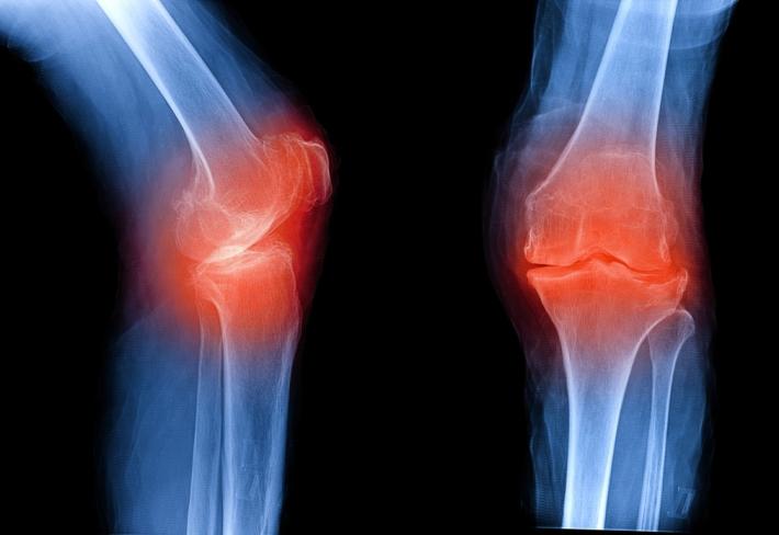 Stop osteoporosi: salva le tue ossa  