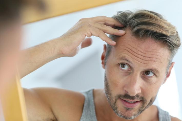 Calvizie, 5 motivi per i quali l&rsquo;uomo perde i capelli