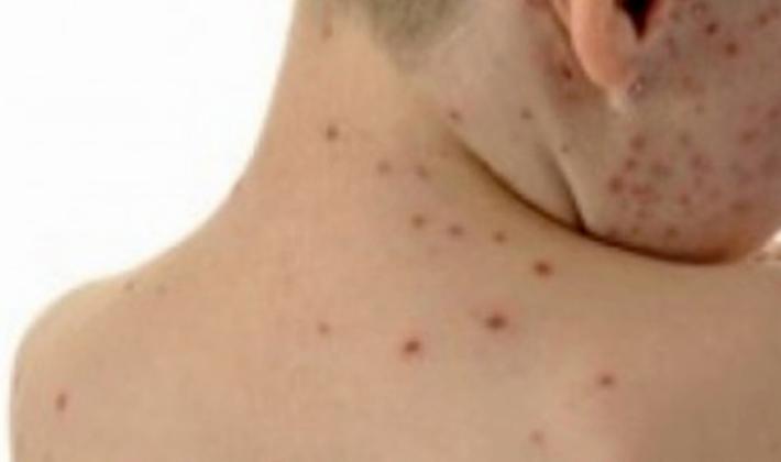 Morbillo, salgono a 22 i casi segnalati da met&agrave; aprile. Due ricoverati al Maggiore