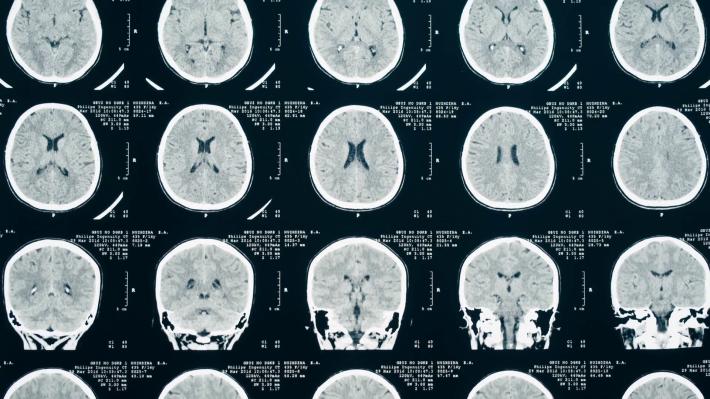 Un esame del sangue salvavita entro 1 ora da trauma cerebrale