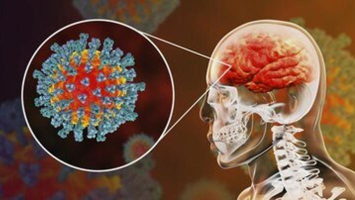 Nebbia nel cervello, sintomo simile a Alzheimer