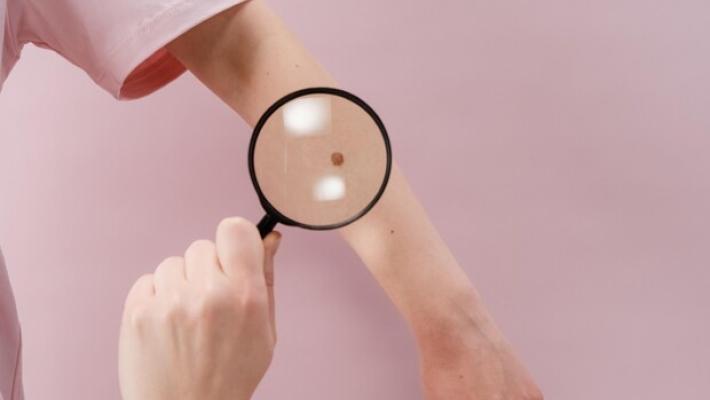 Melanoma, in Italia +7% casi l'anno, fondamentale prevenzione