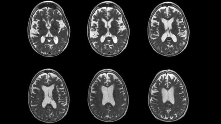Stati Uniti, la Fda autorizza un atteso farmaco contro l'Alzheimer 