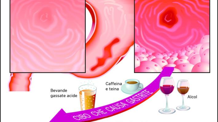 Asma, tosse e denti rovinati? Può essere il reflusso gastroesofageo