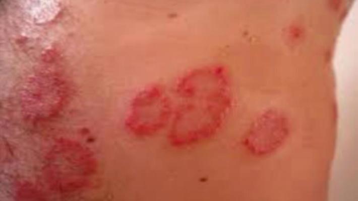 Tre ragazzi con la scabbia alle superiori