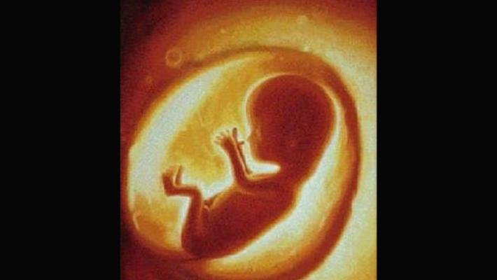 No al cesareo per mancanza di anestesisti: il bimbo muore