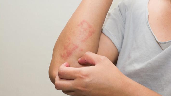 Psoriasi e dermatite atopica, proposto modello per migliorare le cure P