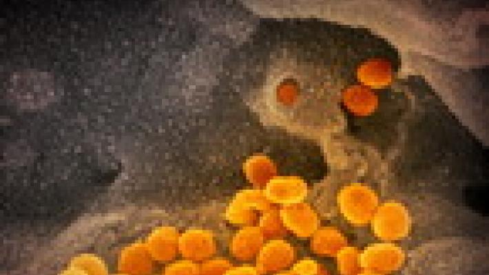 Coronavirus, il mix di antivirali per l'Aids fallisce