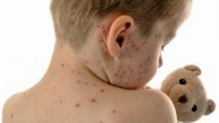 Morbillo: a Parma colpiti soprattutto gli adulti