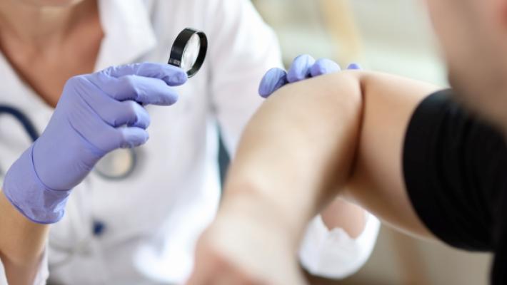 Scabbia, a Parma aumentano i casi anche di bambini e adolescenti: i dati dell'Ausl