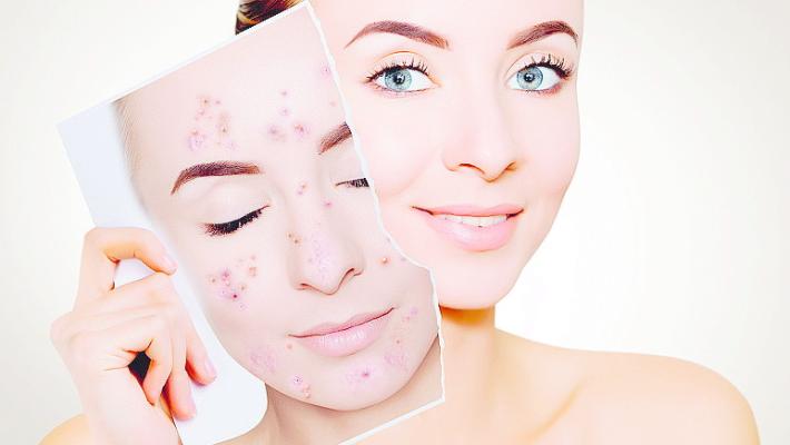 Come «lavare»  una macchia. Soprattutto se ti colpisce il viso 