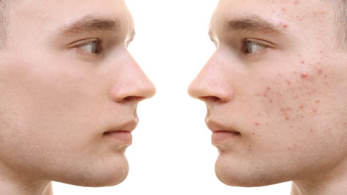 Una pelle a pois. Acne e brufoli: cosa fare