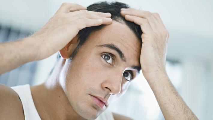 La calvizie cause e soluzioni                             
