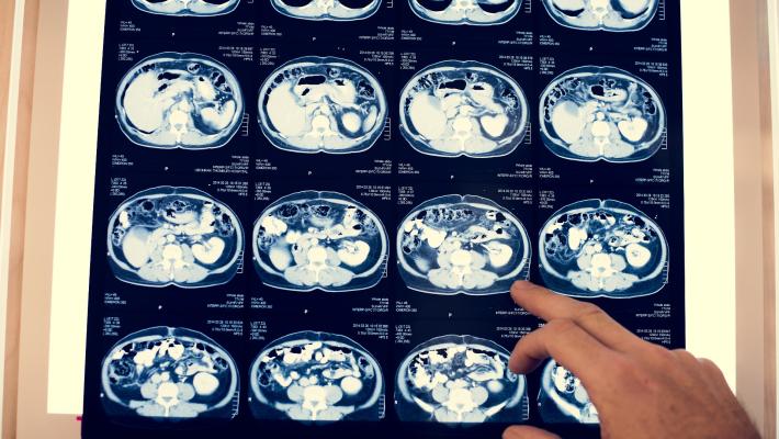 Tumori: un nuovo protocollo riduce fino a al 50% i giorni di ricovero
