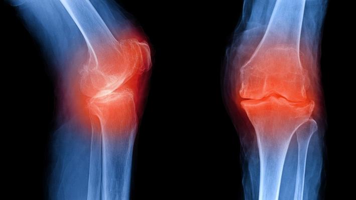 Stop osteoporosi: salva le tue ossa  