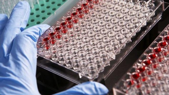 Mieloma multiplo: una ricerca dell’università di Parma suggerisce una nuova via per prevenire le lesioni ossee